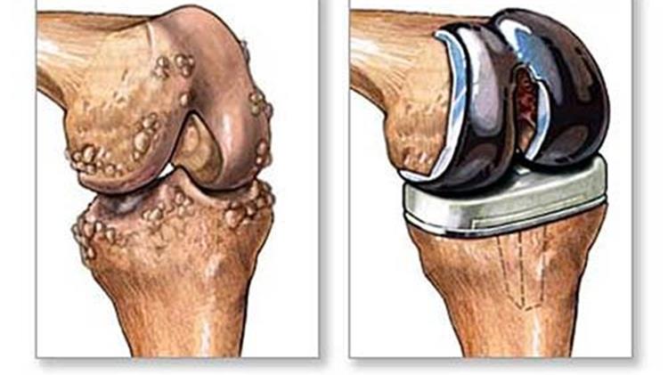 Ολική Αρθροπλαστική Γόνατος