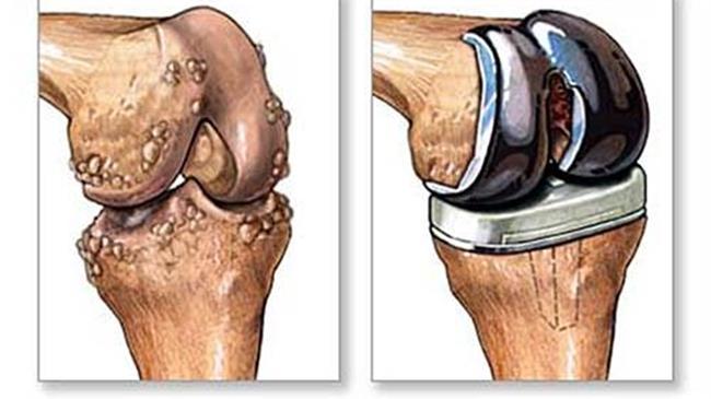 Ολική Αρθροπλαστική Γόνατος